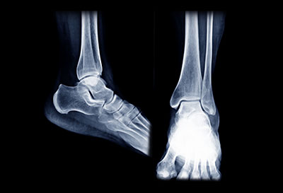 Dexa Scan North Haven CT