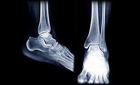 Bone Density DEXA Scan